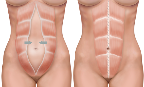 rectus diastesis